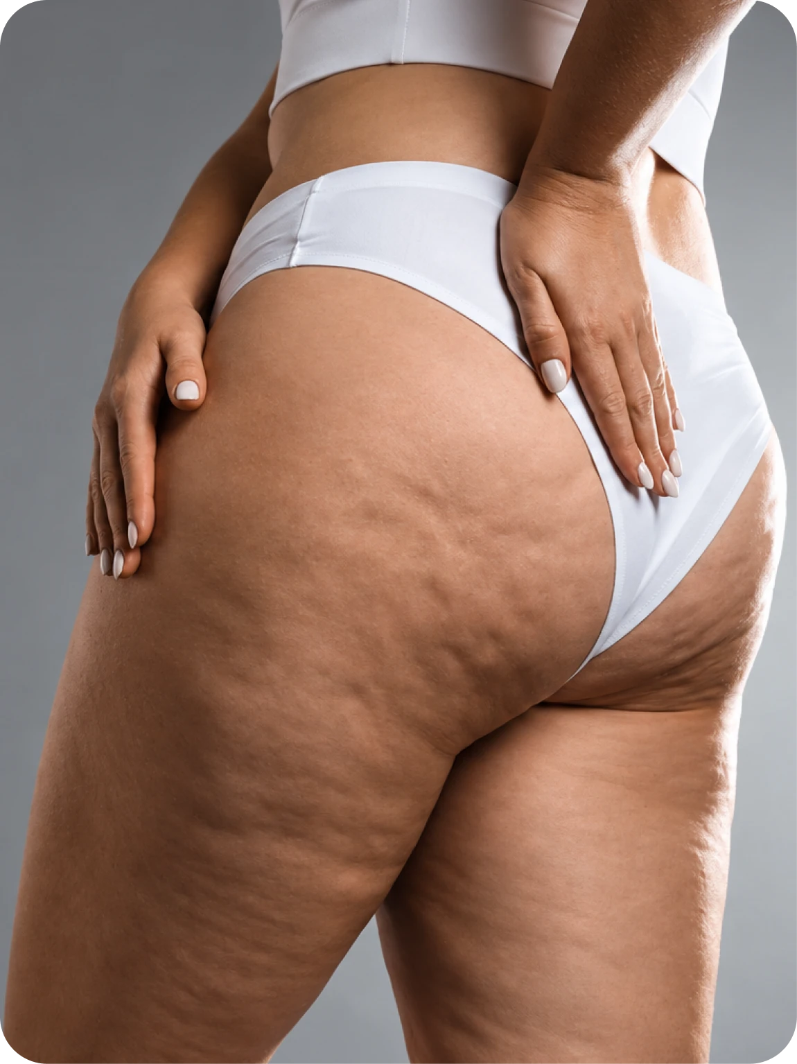 Lipedema