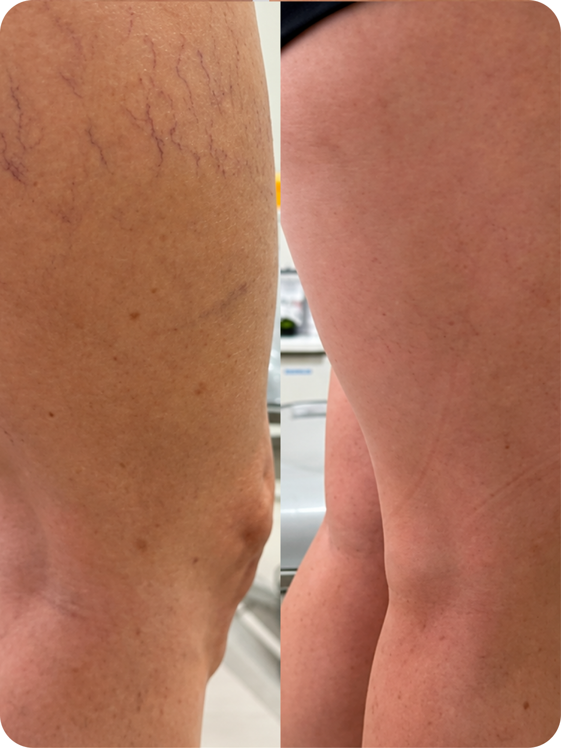 Resultado de tratamento 2 — antes e depois