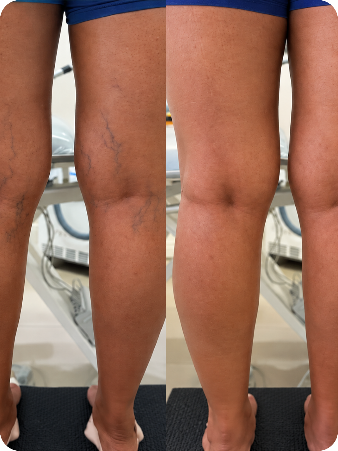 Resultado de tratamento 3 — antes e depois