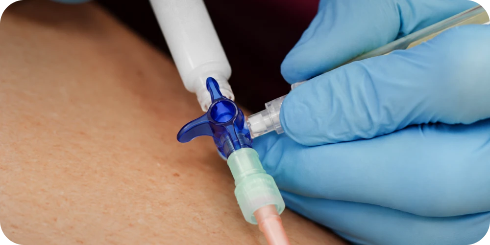 Escleroterapia com espuma